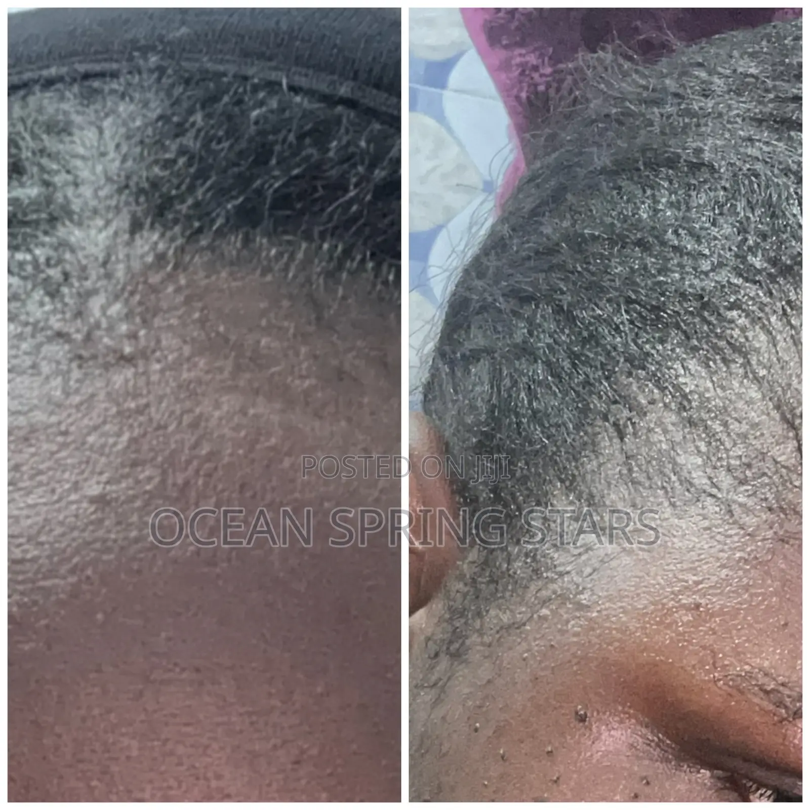 Minoxidil Tropical Solution USP 5%