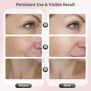 ES-1081 Intense Pulsed Light Wrinkles Reducing Instrument