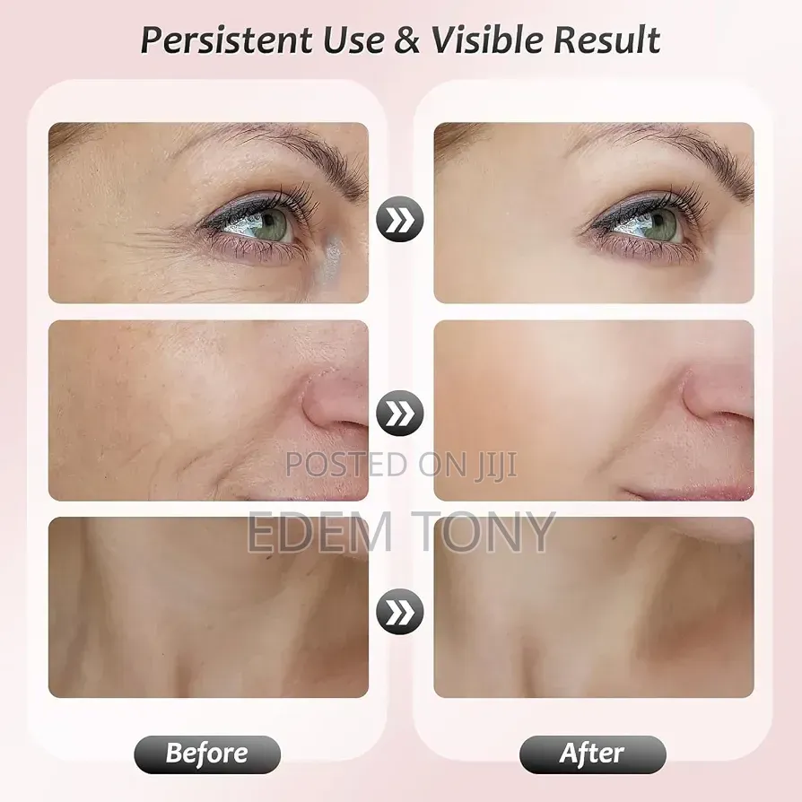 ES-1081 Intense Pulsed Light Wrinkles Reducing Instrument