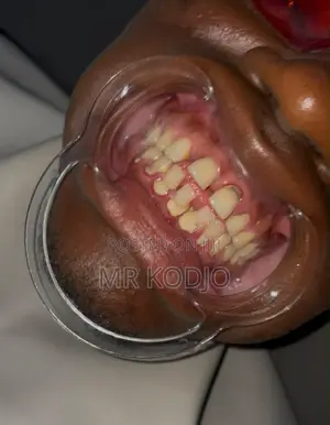 Teeth Cleaning