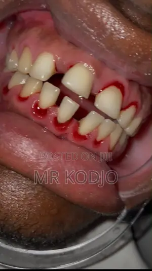 Teeth Cleaning