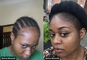 Kirkland Minoxidil