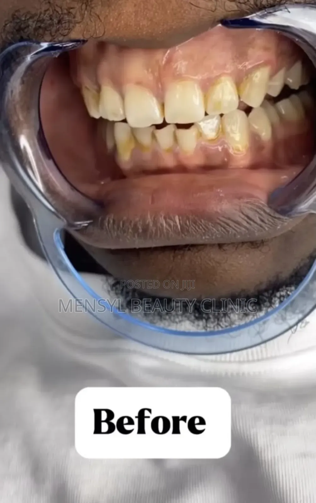 Professional Teeth Whitening 