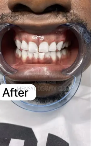 Professional Teeth Whitening 