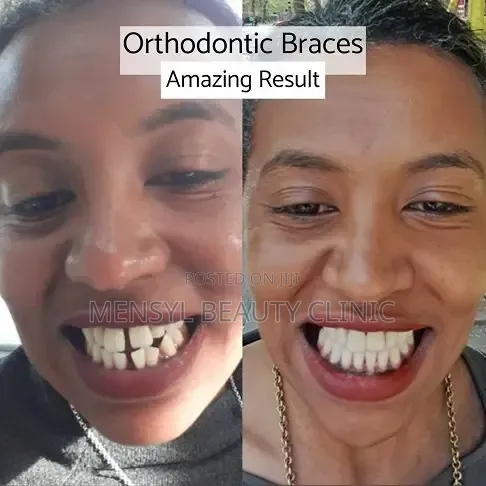 Professional Dental Braces Correction of Alignment Orthodontic