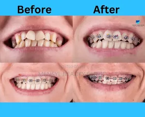 Professional Dental Braces Correction of Alignment Orthodontic