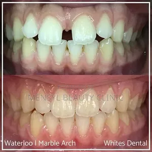 Professional Dental Braces Correction of Alignment Orthodontic