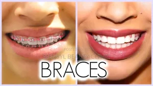 Fashion Braces Available Book Appointment