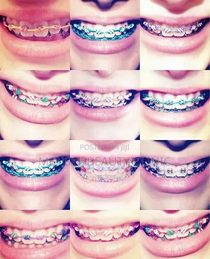 Fashion Braces Available Book Appointment