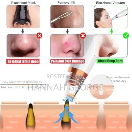 Acne Pimple Vacuum