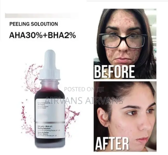 The Ordinary Peeling Solution