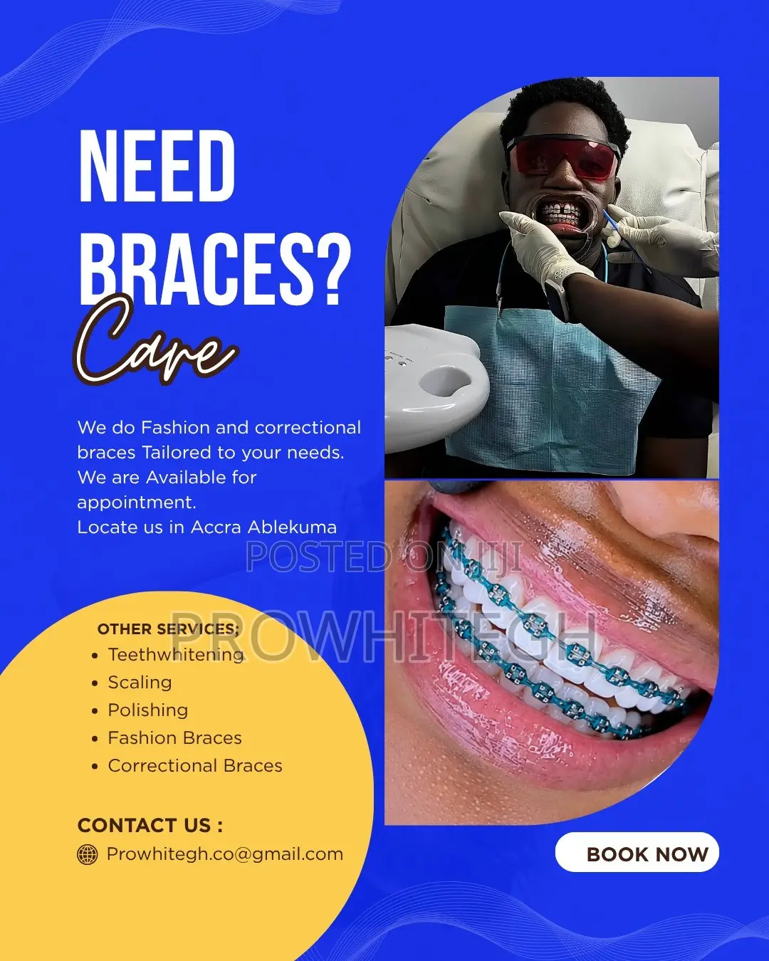 Braces /Fashion Braces