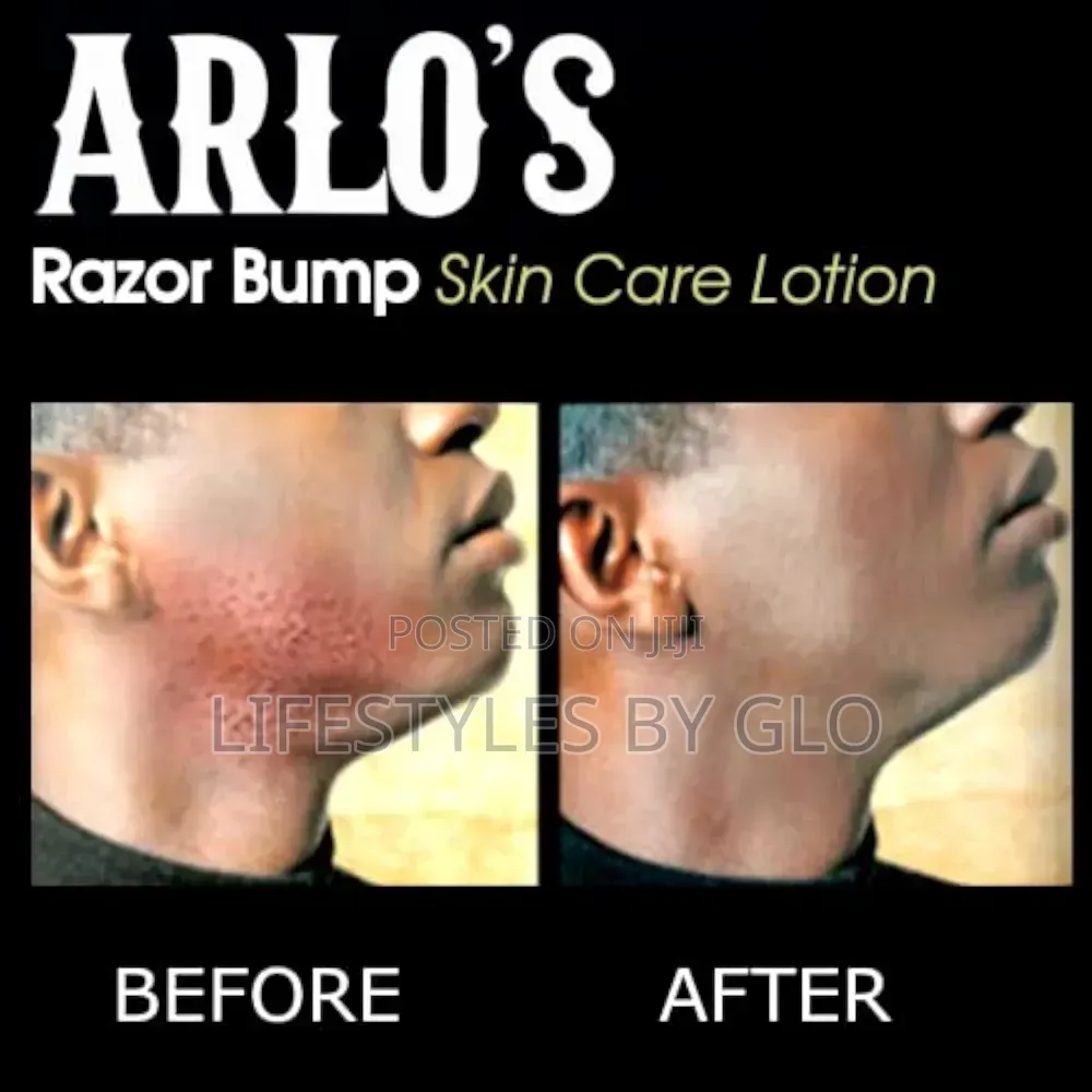 Arlo's Razor Bump Skin Care Lotion