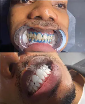 Teeth Whitening Service