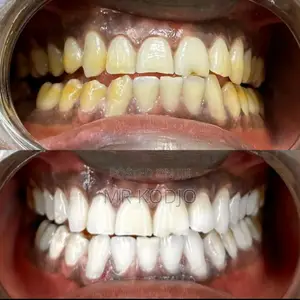 Teeth Whitening Service