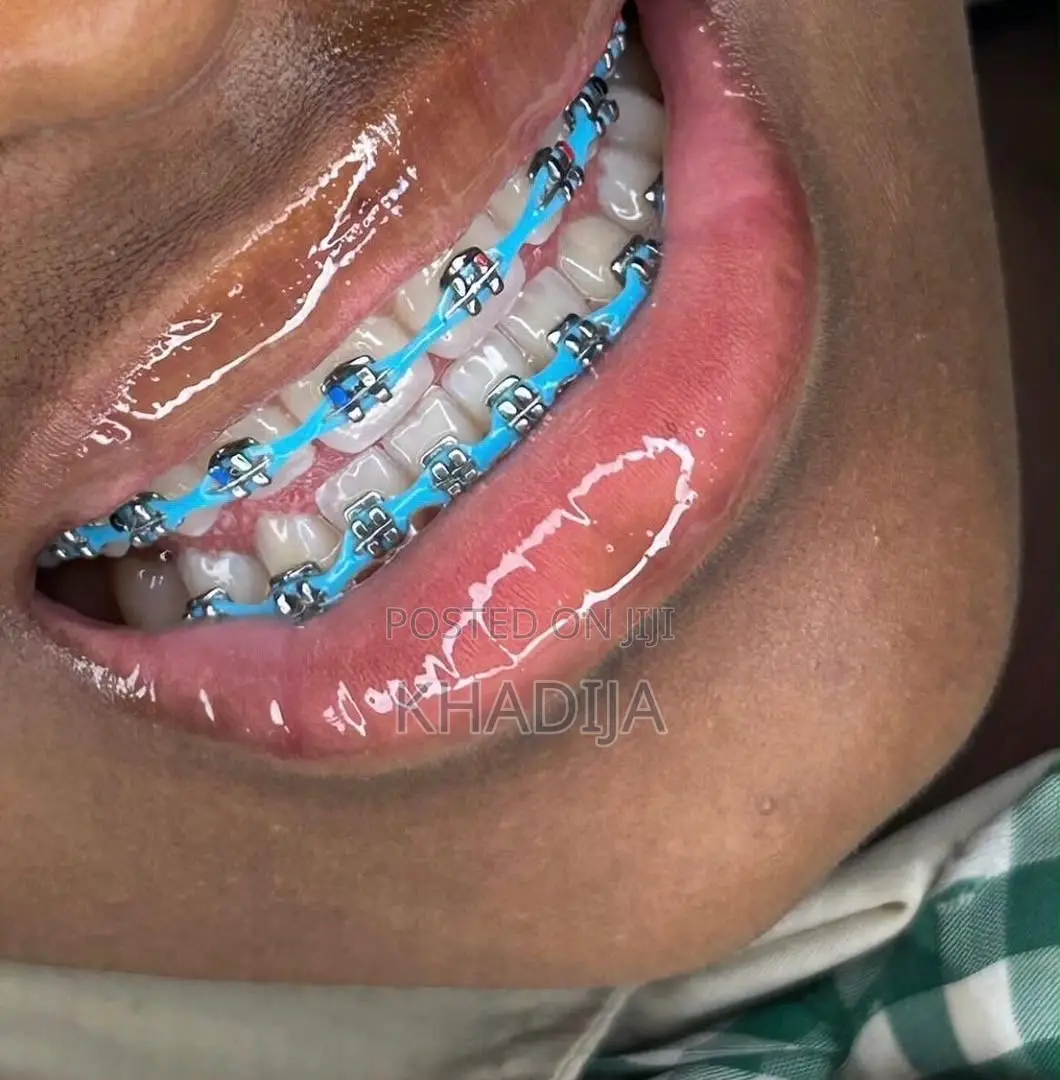 Fashion Braces