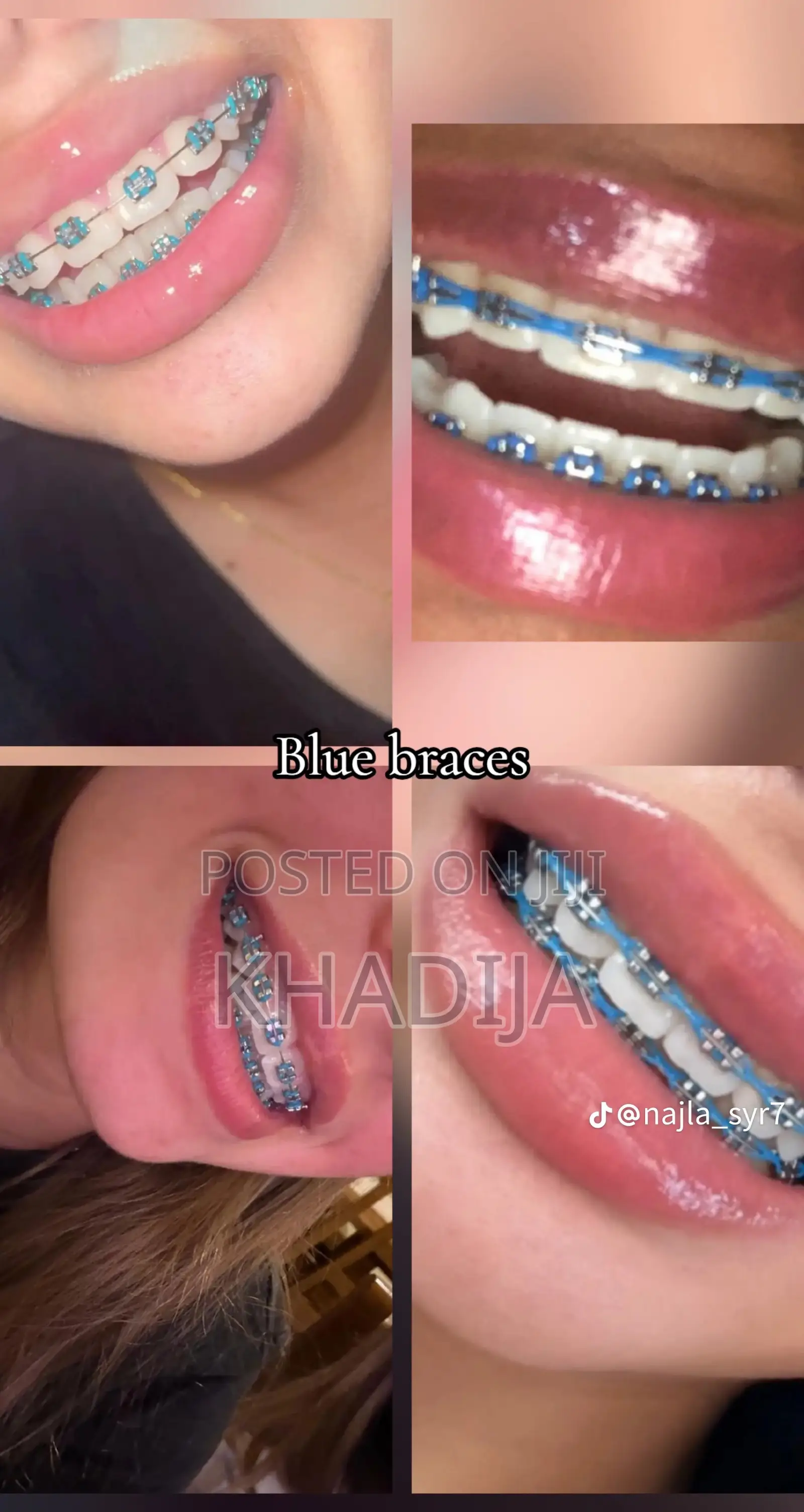 Fashion Braces