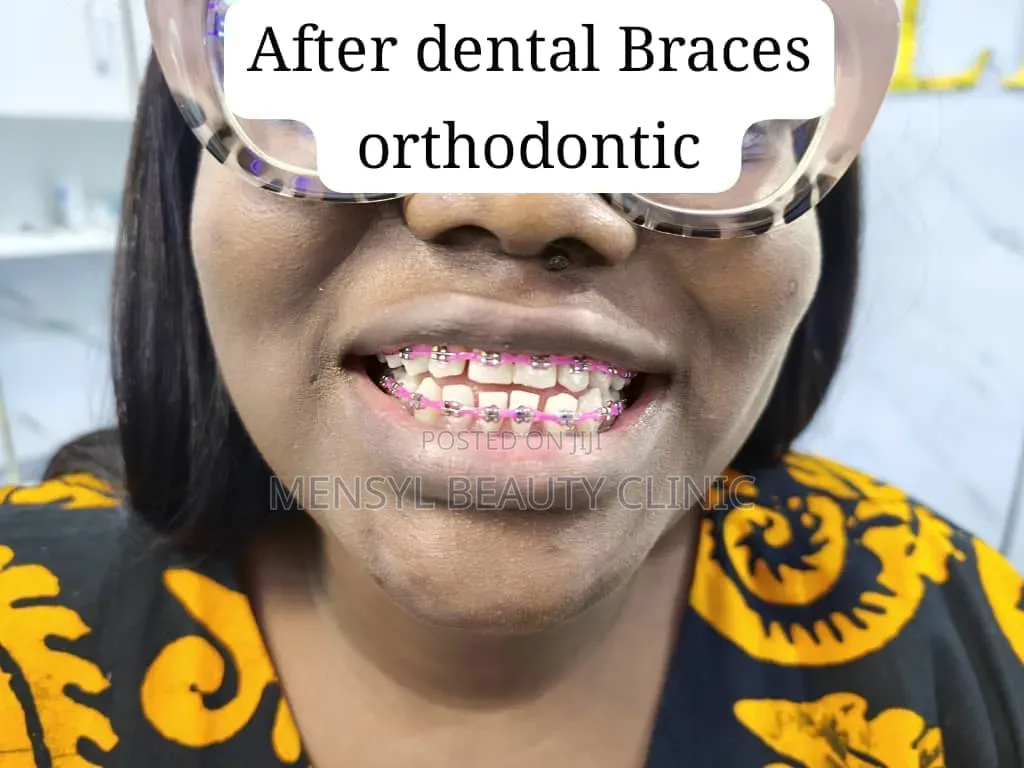 Fashion Braces Available Book Appointment