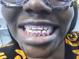 Fashion Braces Available Book Appointment