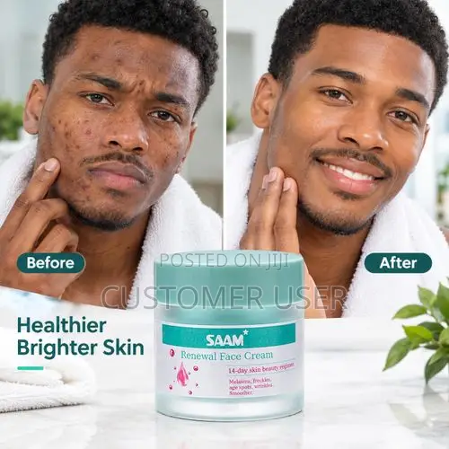 Saam Cream - Acne Remover -Skin Brighten