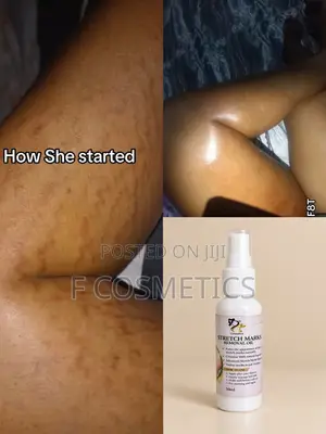 Stretchmarks Oil