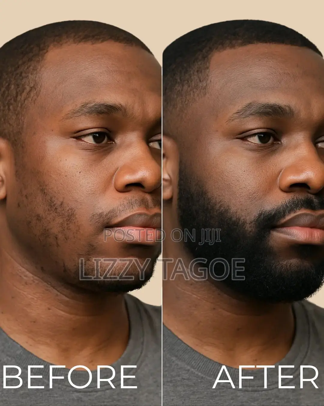 Kirkland Foam (Quick Dry /Works Faster -for Hairline and Beard Growth)